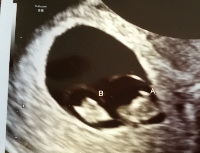 Black and white ultrasound image showing twin babies, labeled A and B